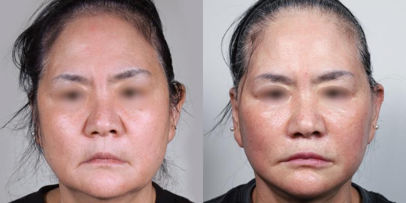 안면거상 1개월