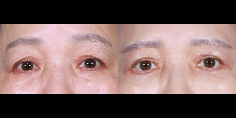 눈썹하거상,하안검 1개월