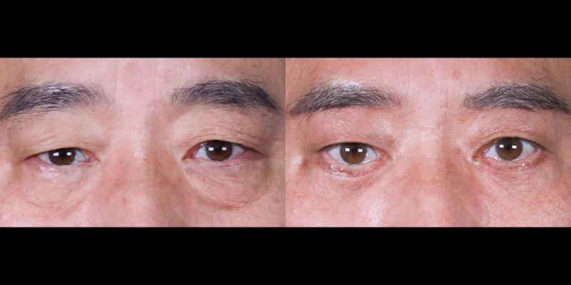 눈썹하거상,하안검 1개월