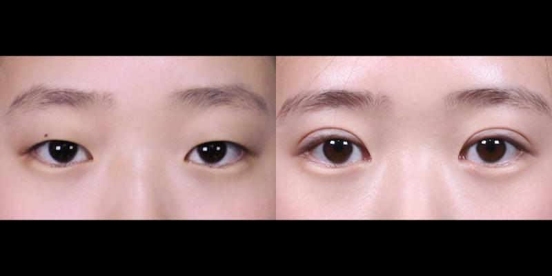 쌍꺼풀,앞트임 3개월