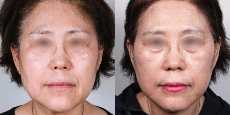 안면거상 1개월