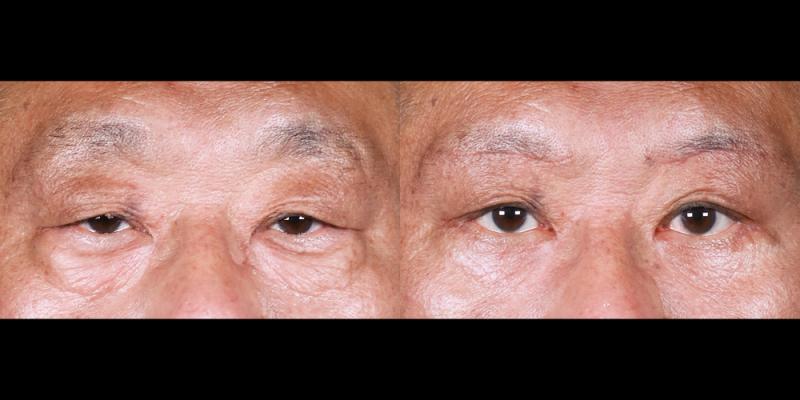 눈썹하거상,하안검 1개월