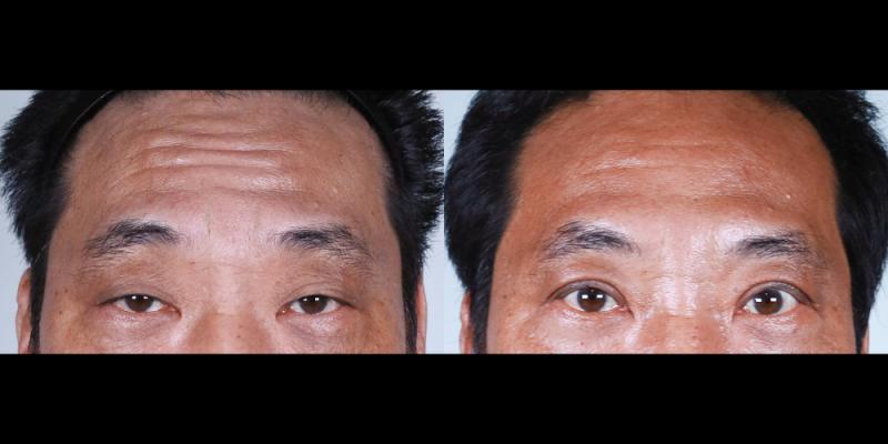 이마거상,상안검 1개월