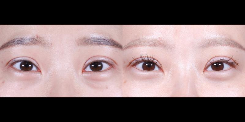 눈안지방재배치 3개월