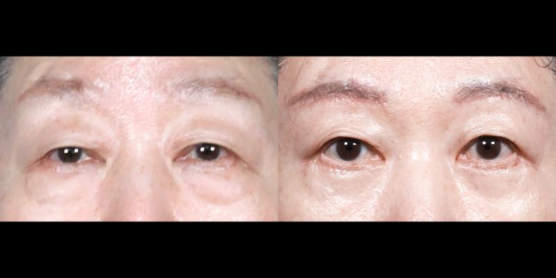 눈썹하거상, 하안검