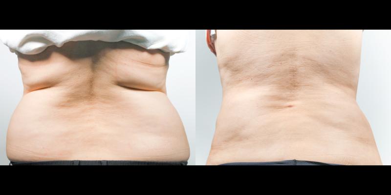 복부지방흡입(뒤) 1개월