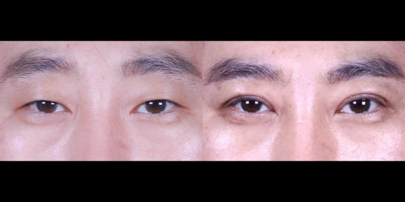 쌍꺼풀(실밥제거 후)