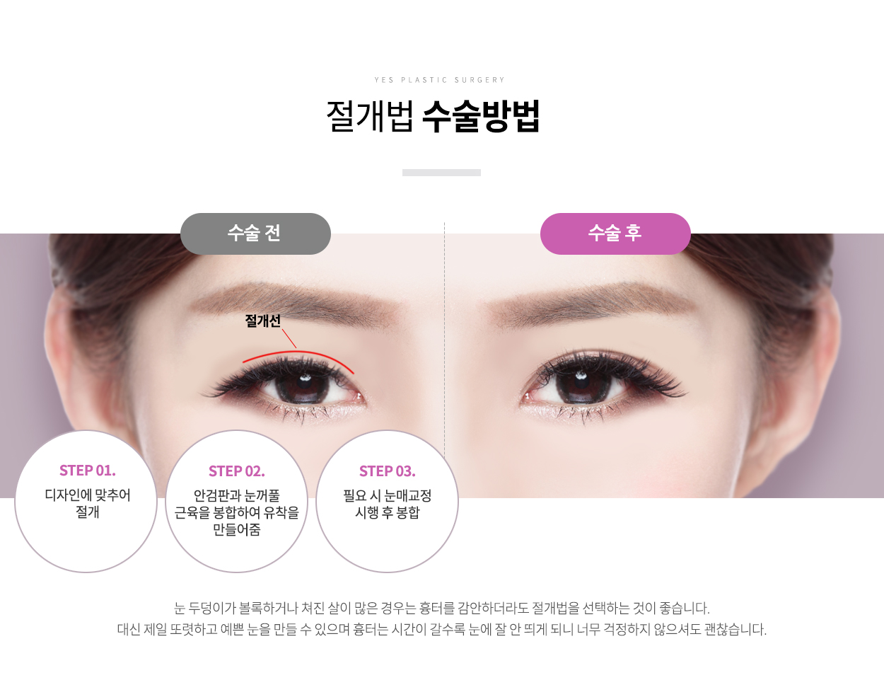 절개법수술방법