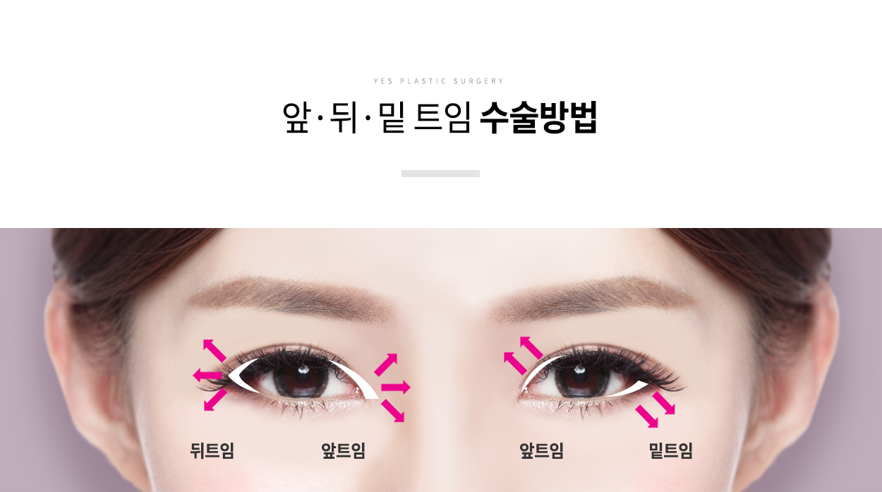 앞뒤밑트임수술방법