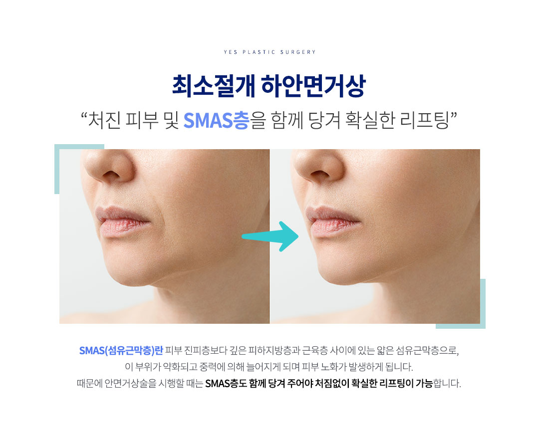 최소절개 안면거상