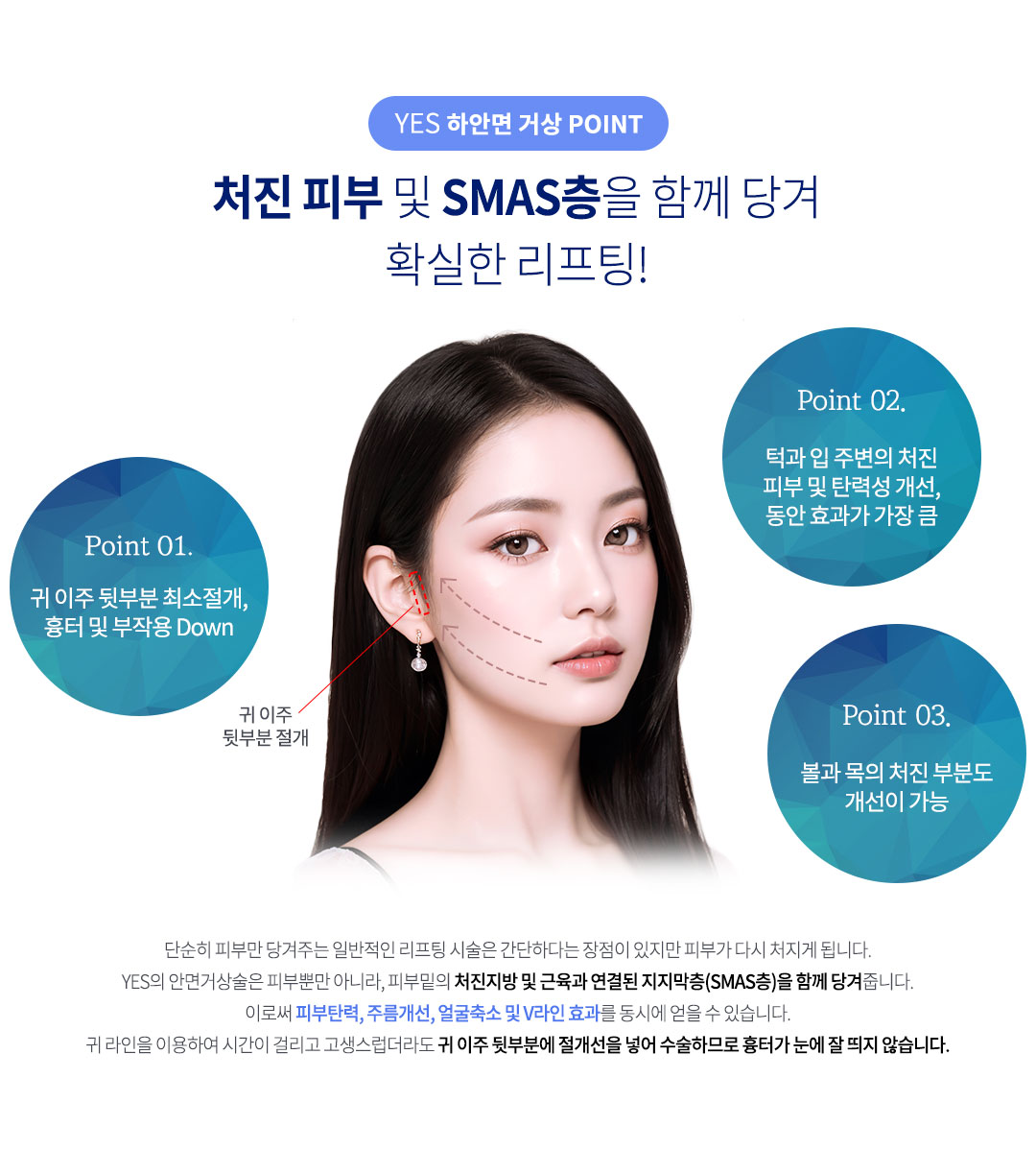 하안면거상 포인트