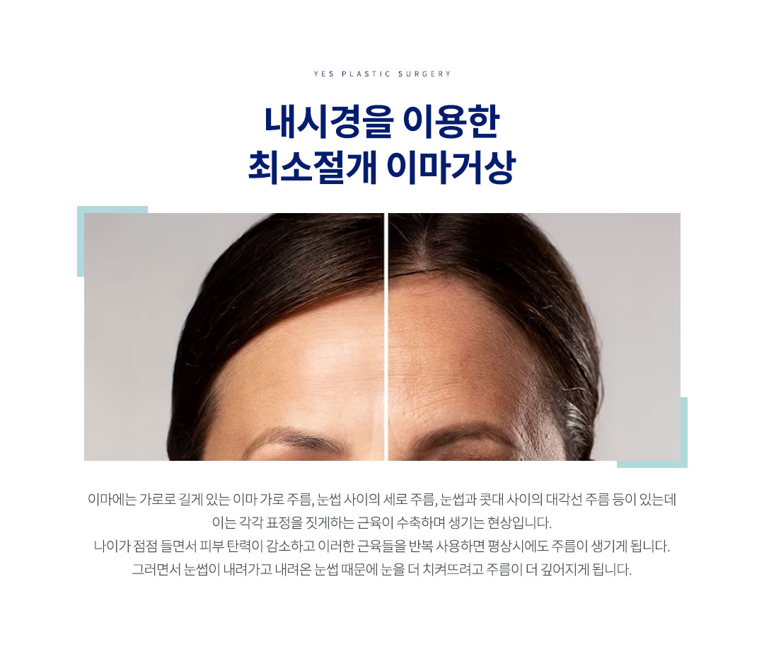 내시경 이마 거상 리프팅