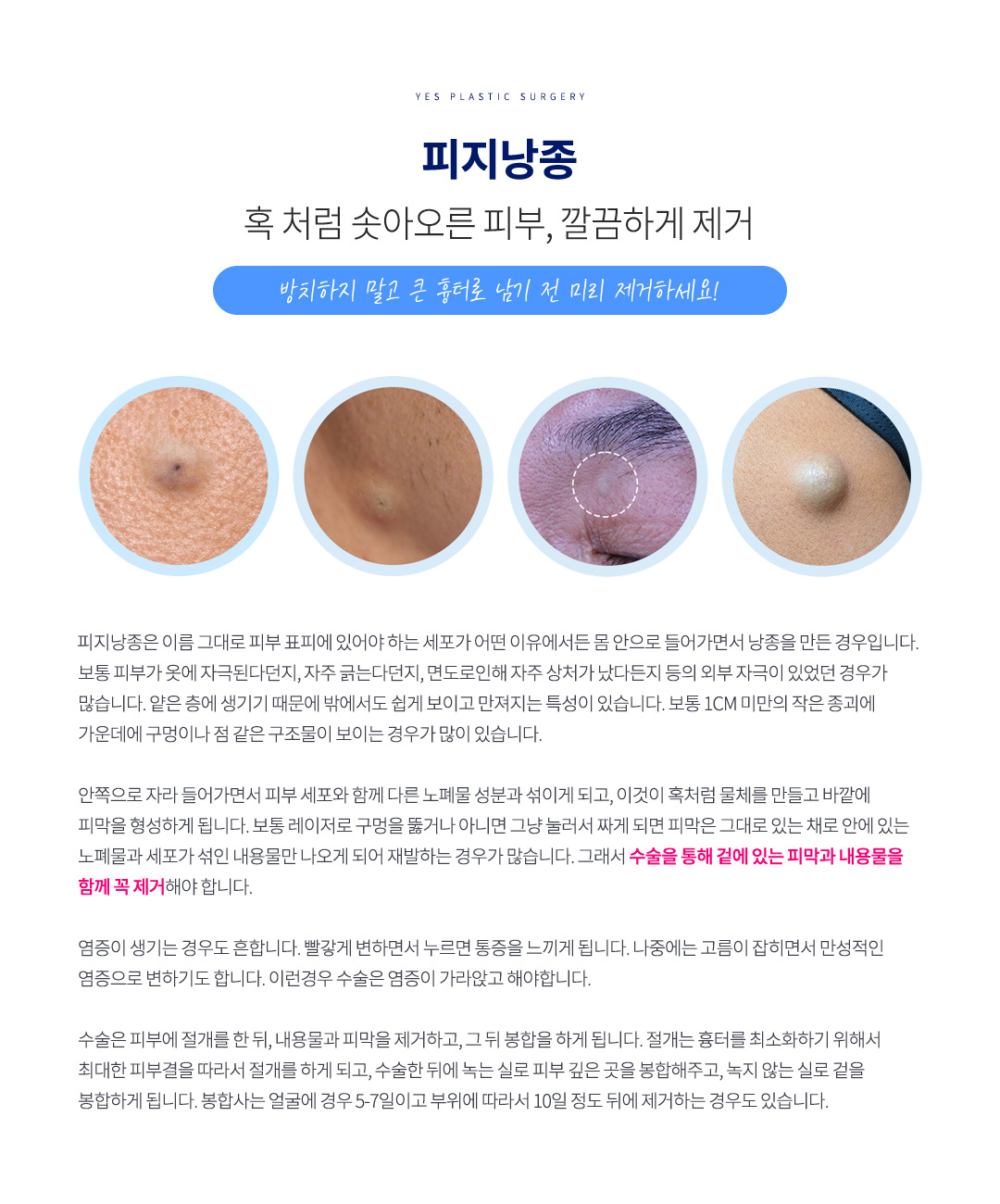 표피낭종